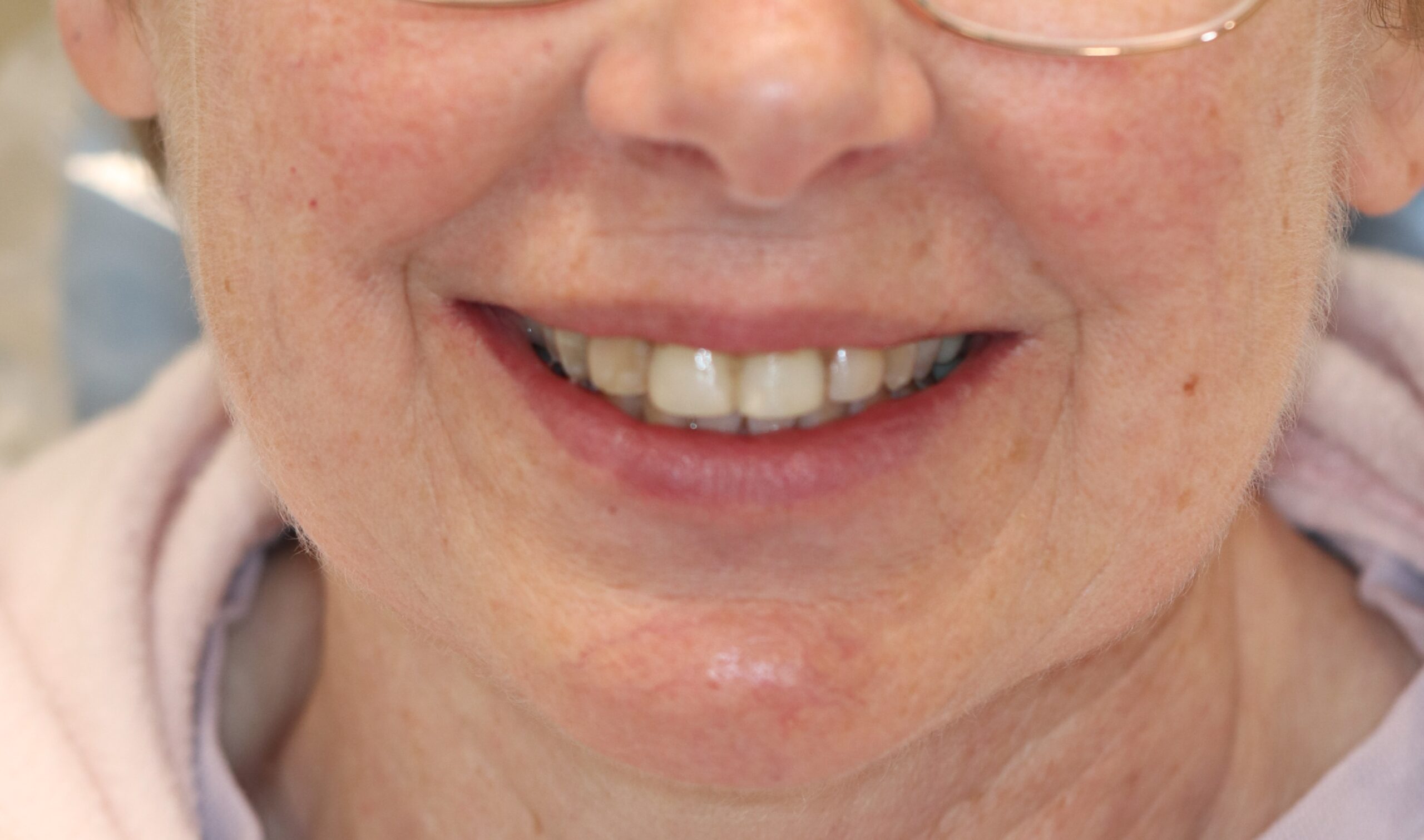 Case4 Veneer Before1