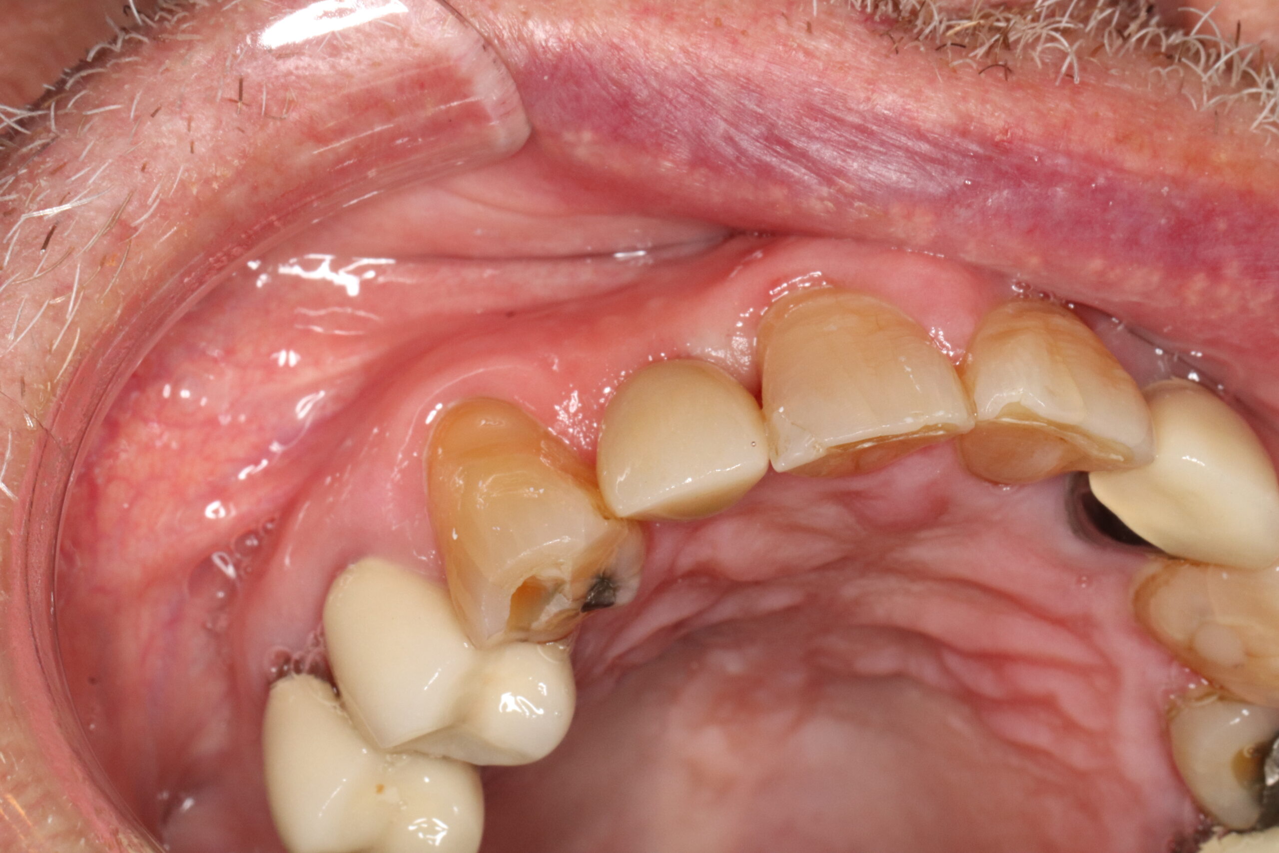 Case5 Implant After