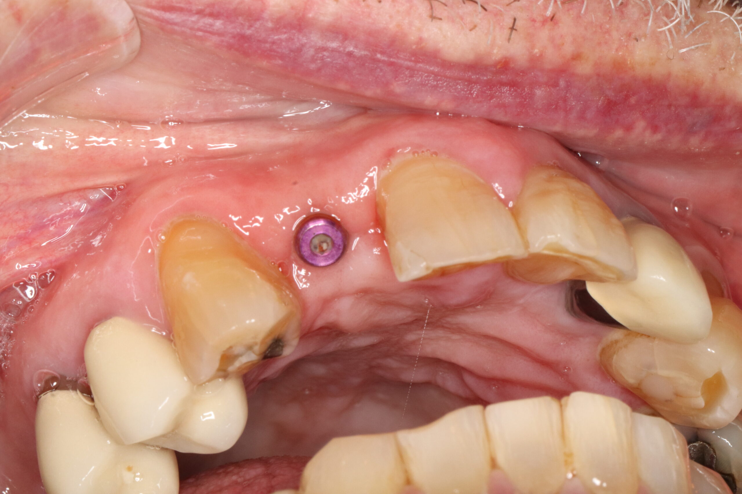 Case5 Implant Before