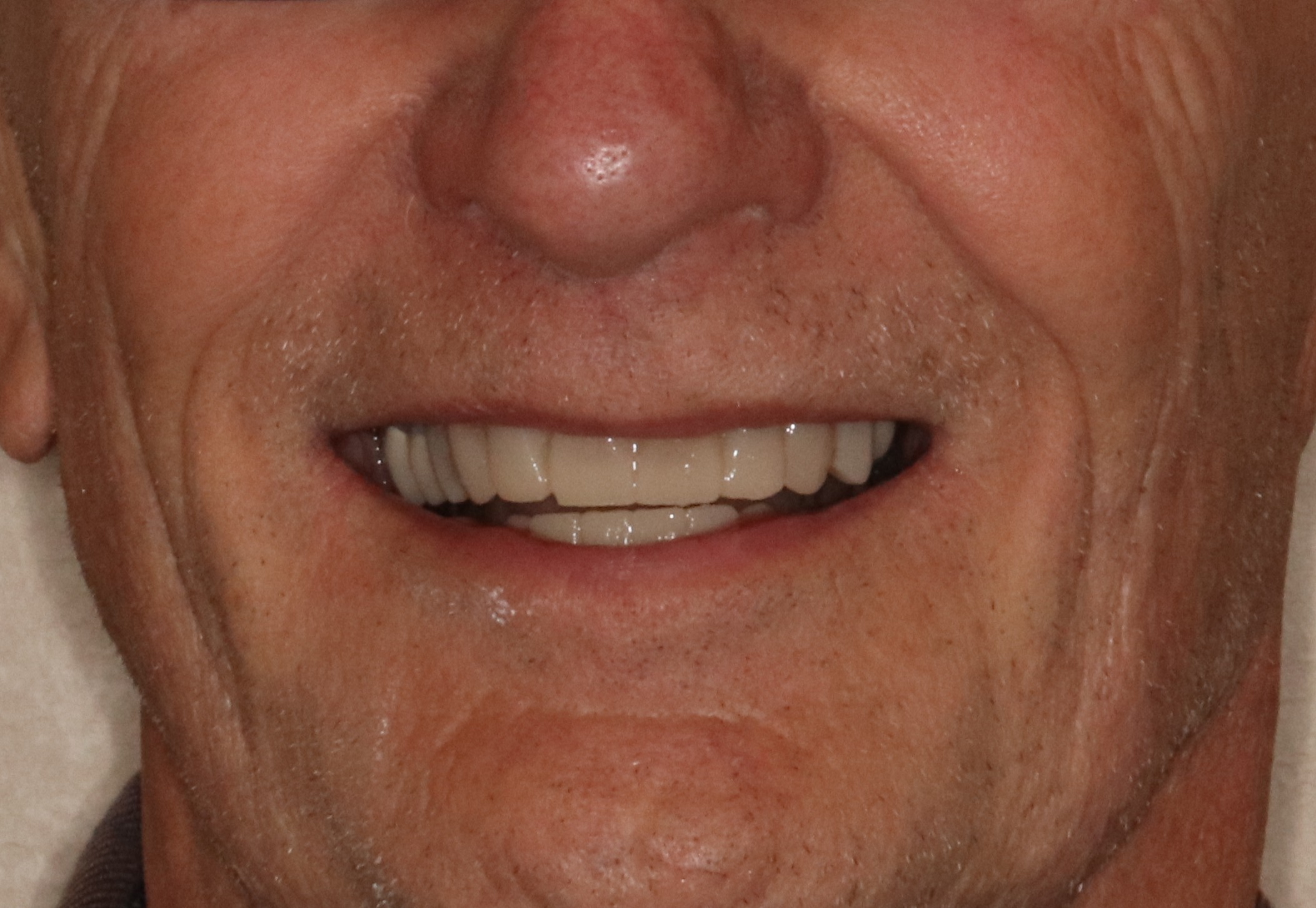 Case6 Full Mouth After