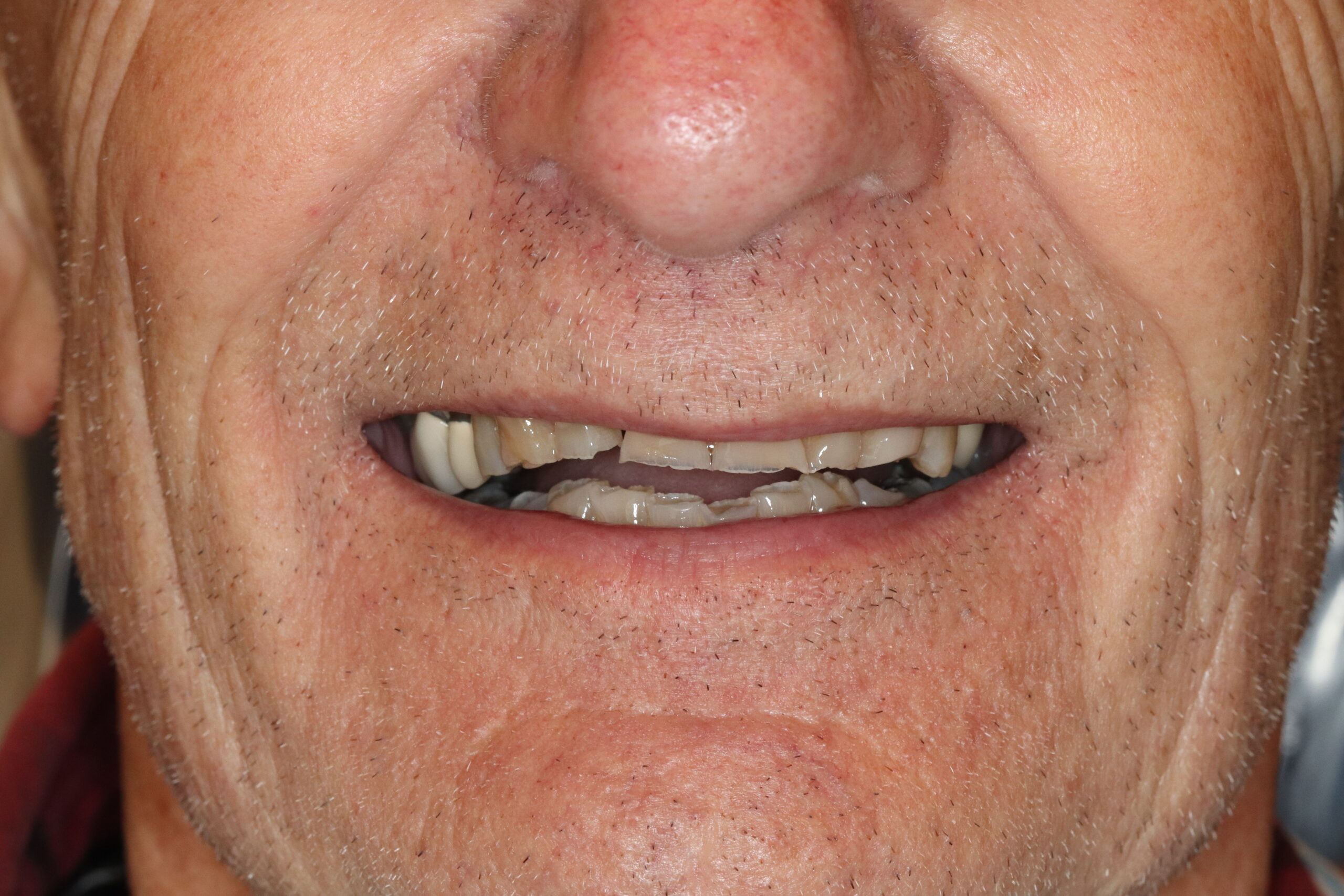 Case6 Full Mouth Before