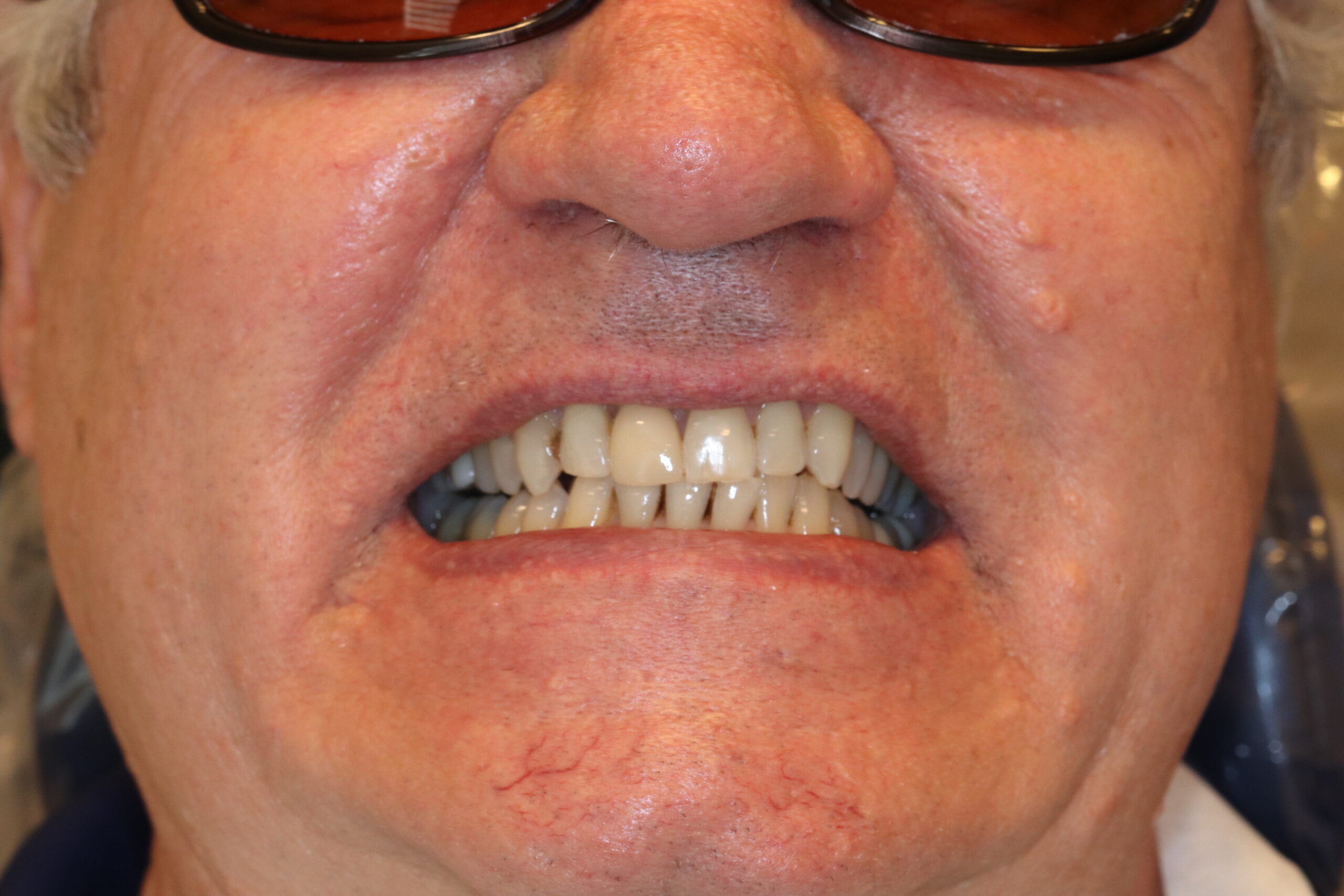 Case7 Implant After