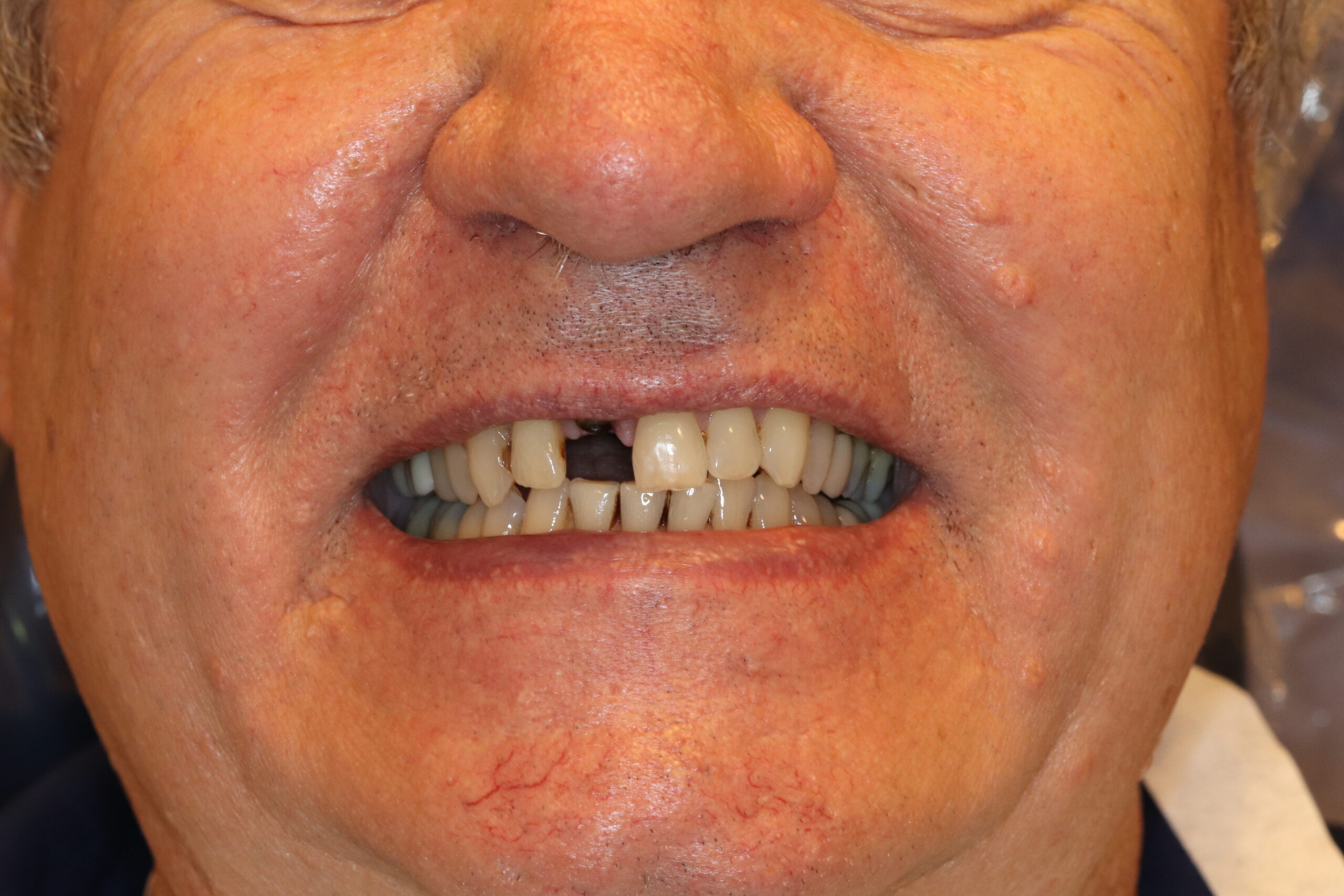 Case7 Implant Before