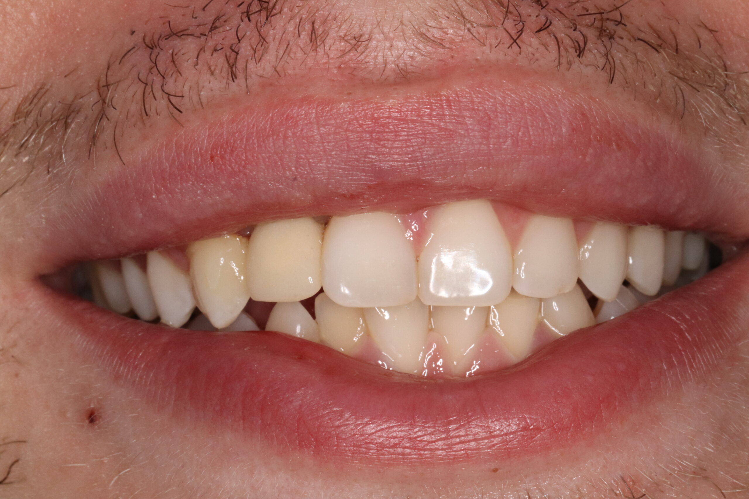 Case9 Implant After
